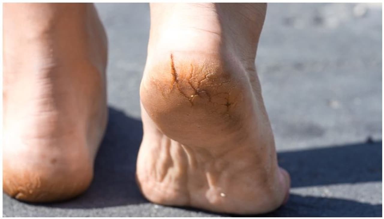 <p>కాలంతో సంబంధం లేకుండా కొందరికి కాళ్ల పగళ్లు ఇబ్బంది పెడుతుంటాయి. చాలా మంది దీనిని పెద్ద సమస్యగా చూడరు. అవే తగ్గిపోతాయిలే అని పట్టించుకోవడం మానేస్తారు.</p> <p>కాలంతో సంబంధం లేకుండా కొందరికి కాళ్ల పగళ్లు ఇబ్బంది పెడుతుంటాయి. చాలా మంది దీనిని పెద్ద సమస్యగా చూడరు. అవే తగ్గిపోతాయిలే అని పట్టించుకోవడం మానేస్తారు.</p>