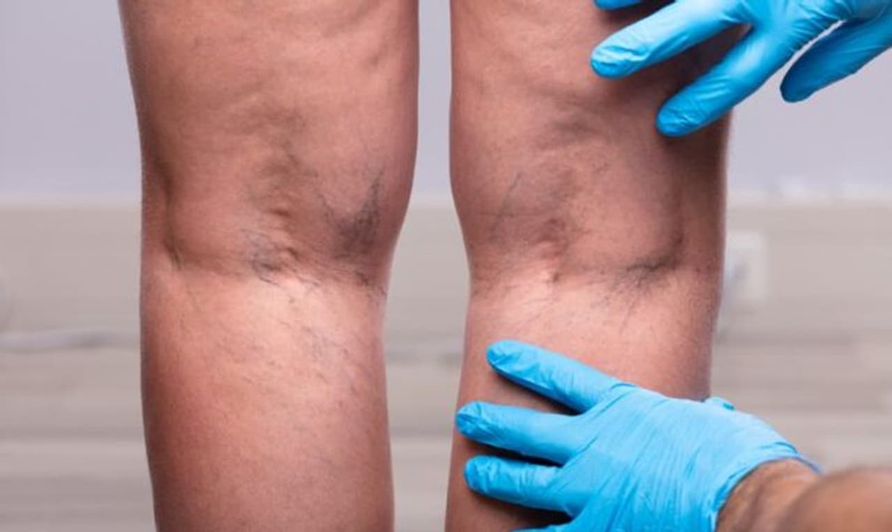 Varicose Veins Symptoms: