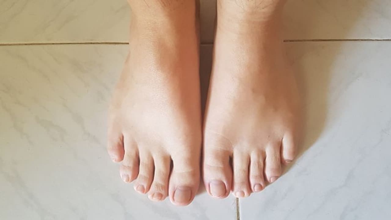Home Remedies for Swollen Feet