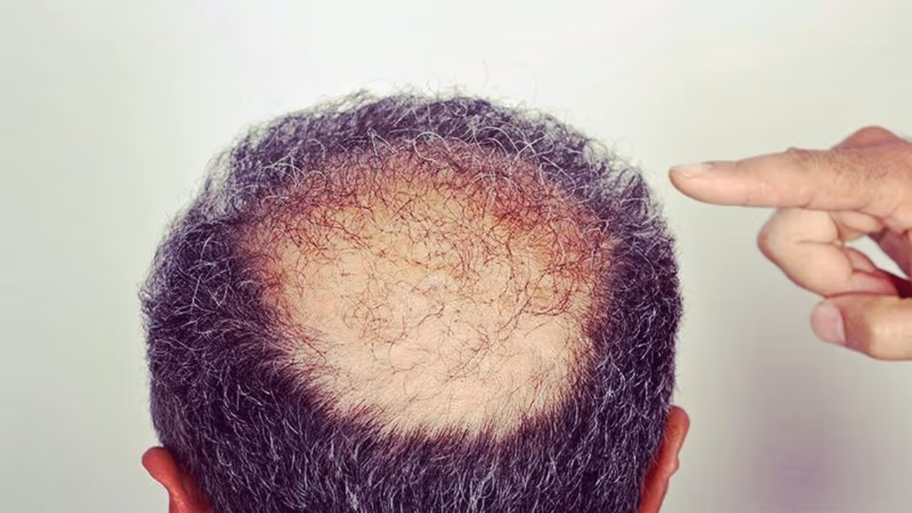 Hair Growth Tips For Bald Head In Tamil