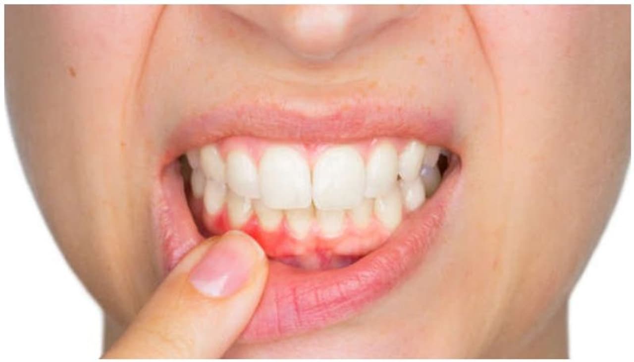 Home Remedies For Bleeding Gums In Tamil