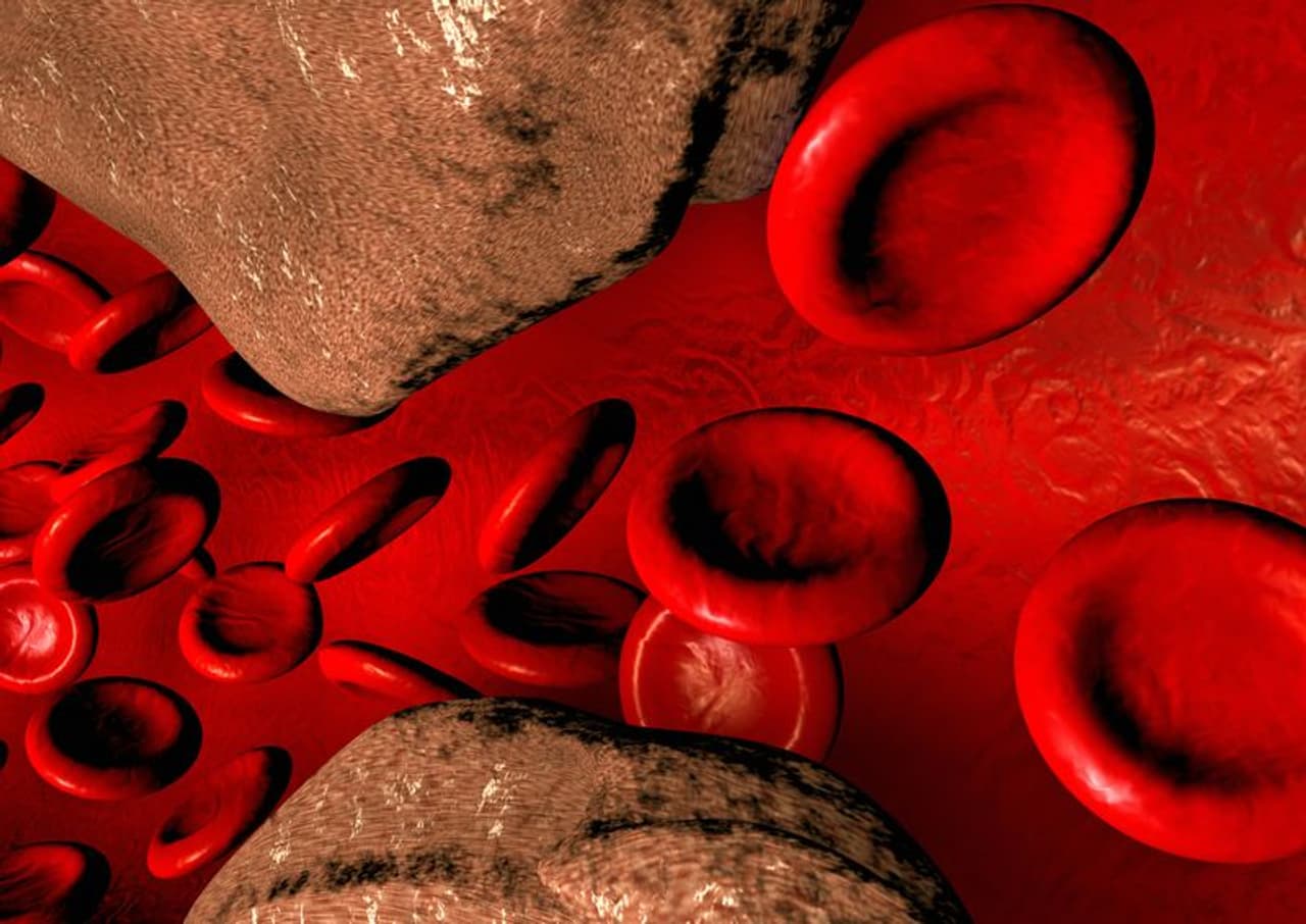 High Cholesterol High Cholesterol