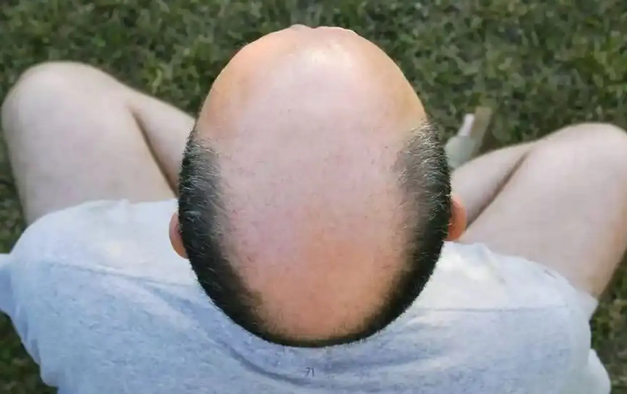 bald bald