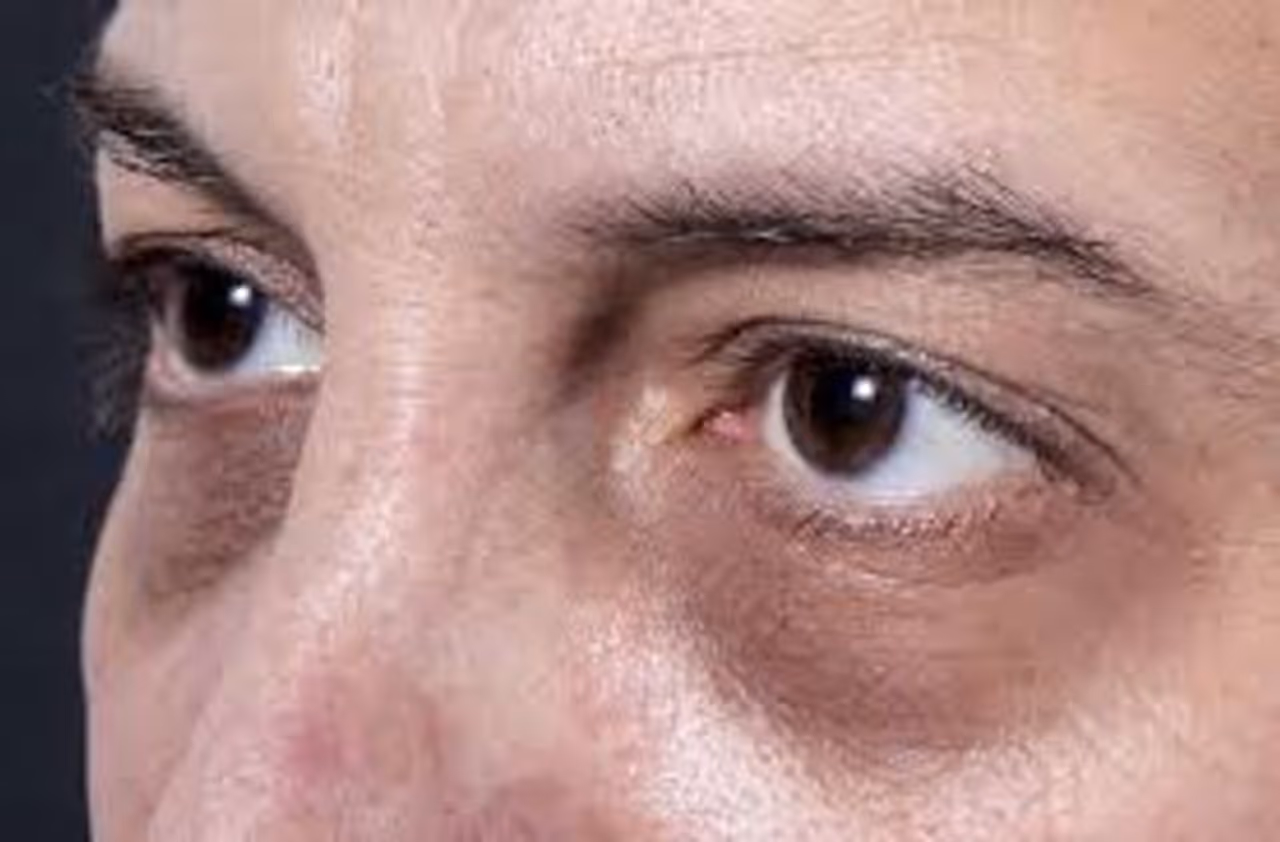 Raw Milk For Dark Circles In Tamil