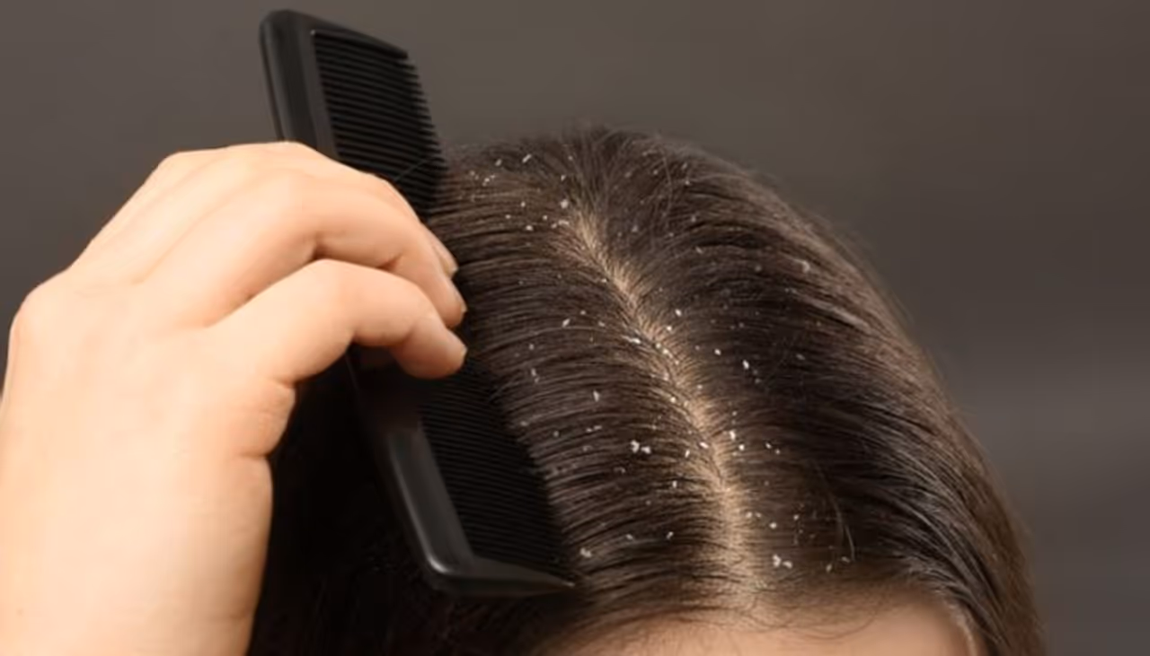 dandruff dandruff