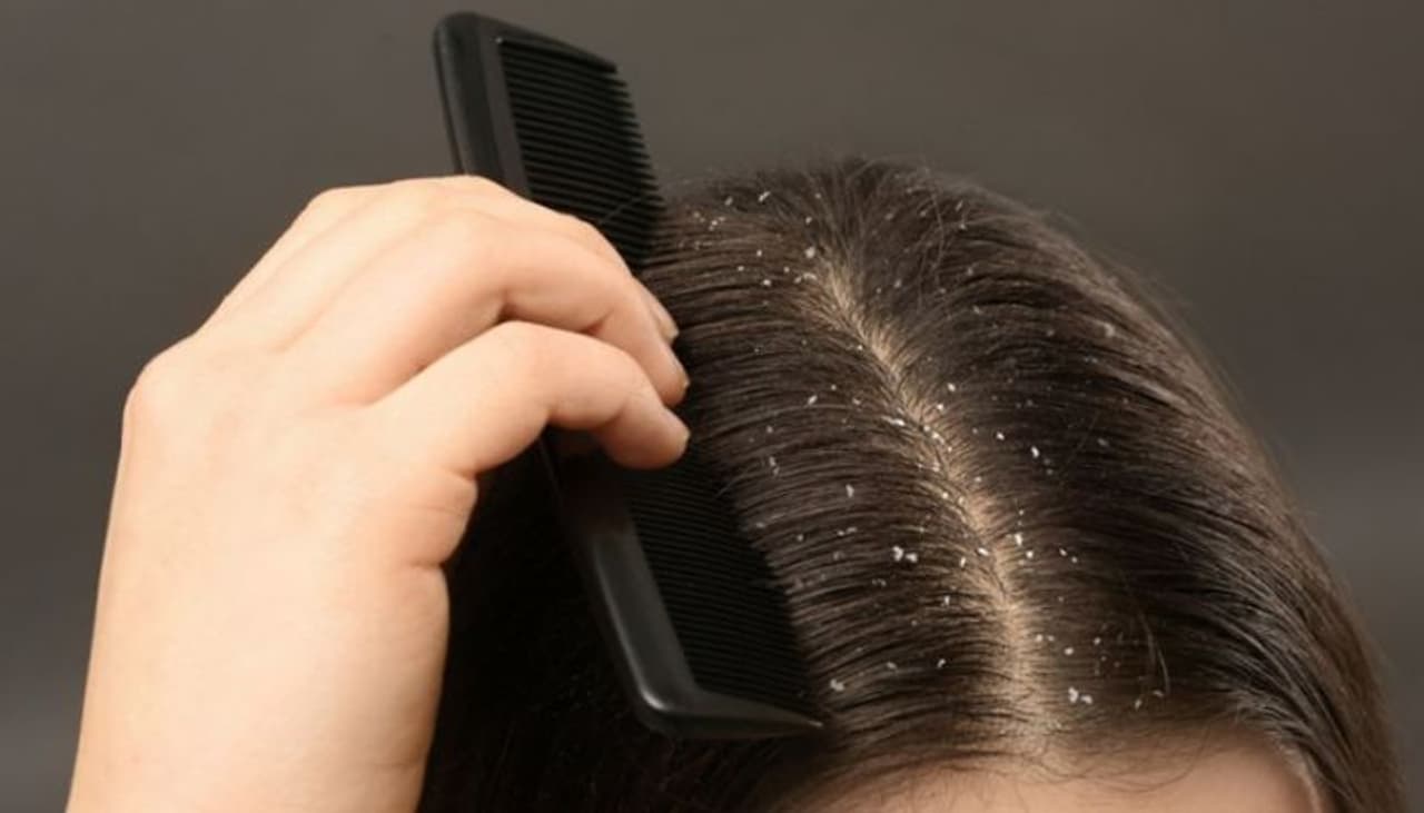 dandruff dandruff
