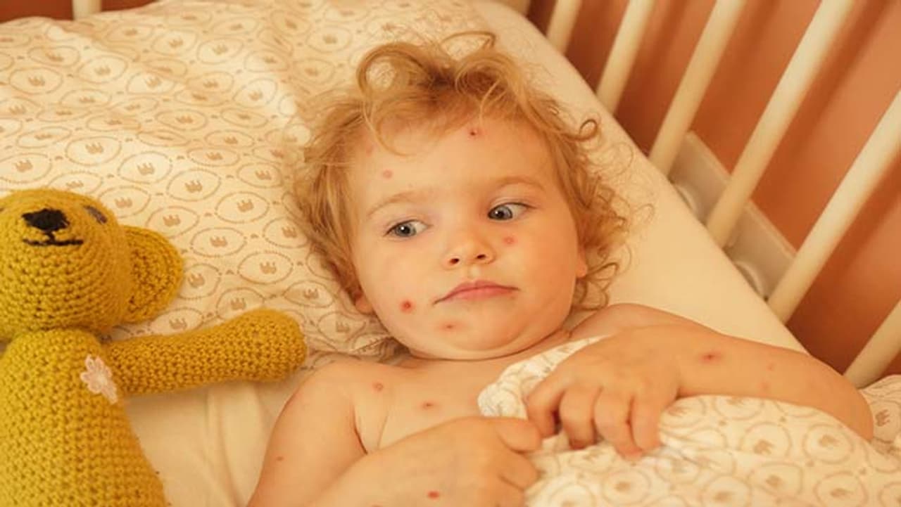 जानें चिकन पॉक्स से जुड़ी मान्यता जानें चिकन पॉक्स से जुड़ी मान्यता