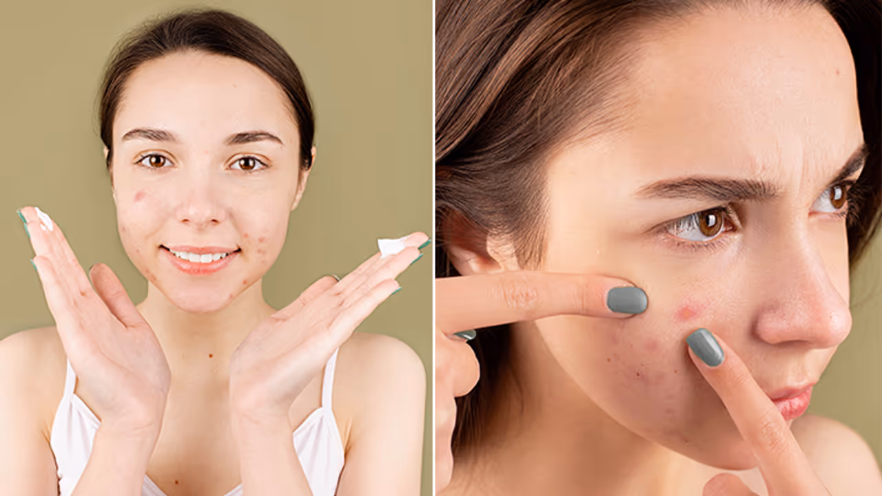 एक्ने के लिए जानें 3 होममेड फेस पैक