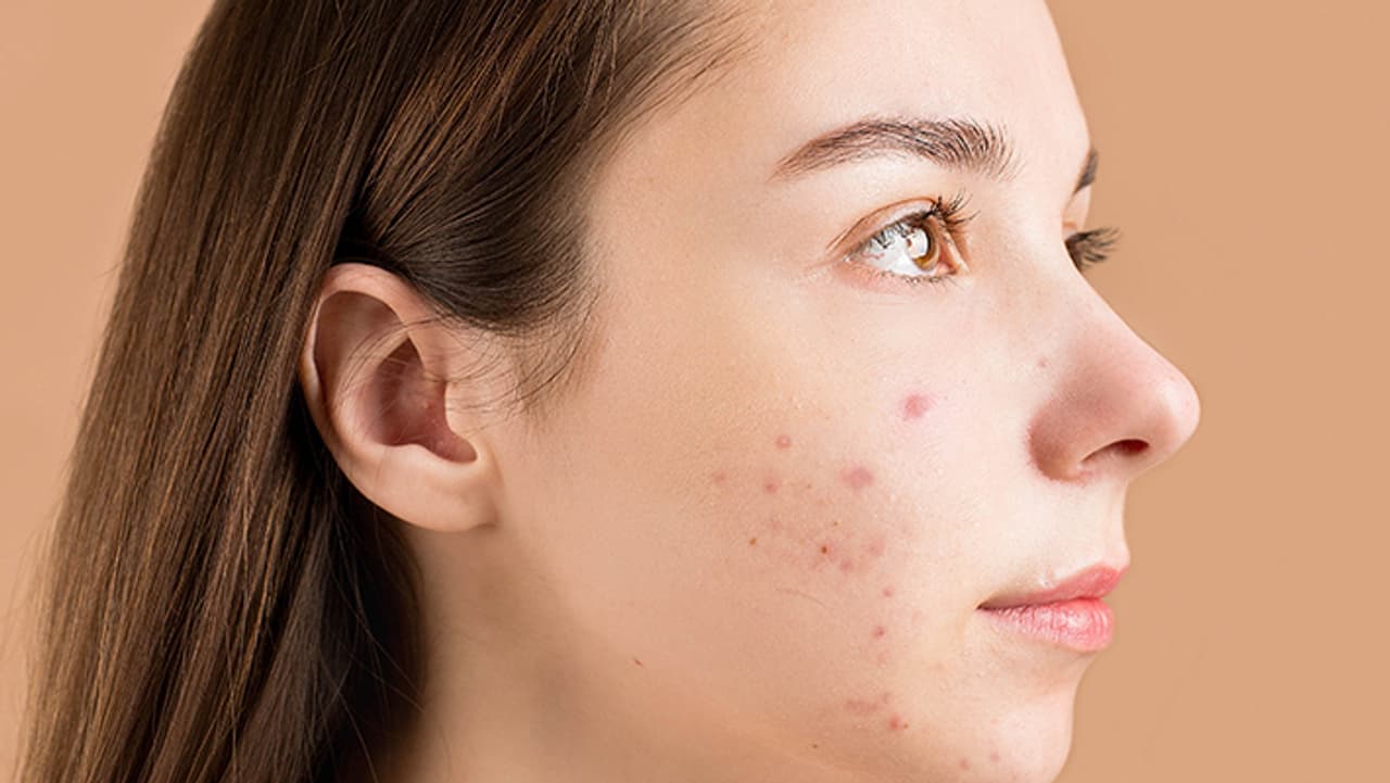 ব্রণের সমস্যায় মুশকিল আসান বরফ ব্রণের সমস্যায় মুশকিল আসান বরফ