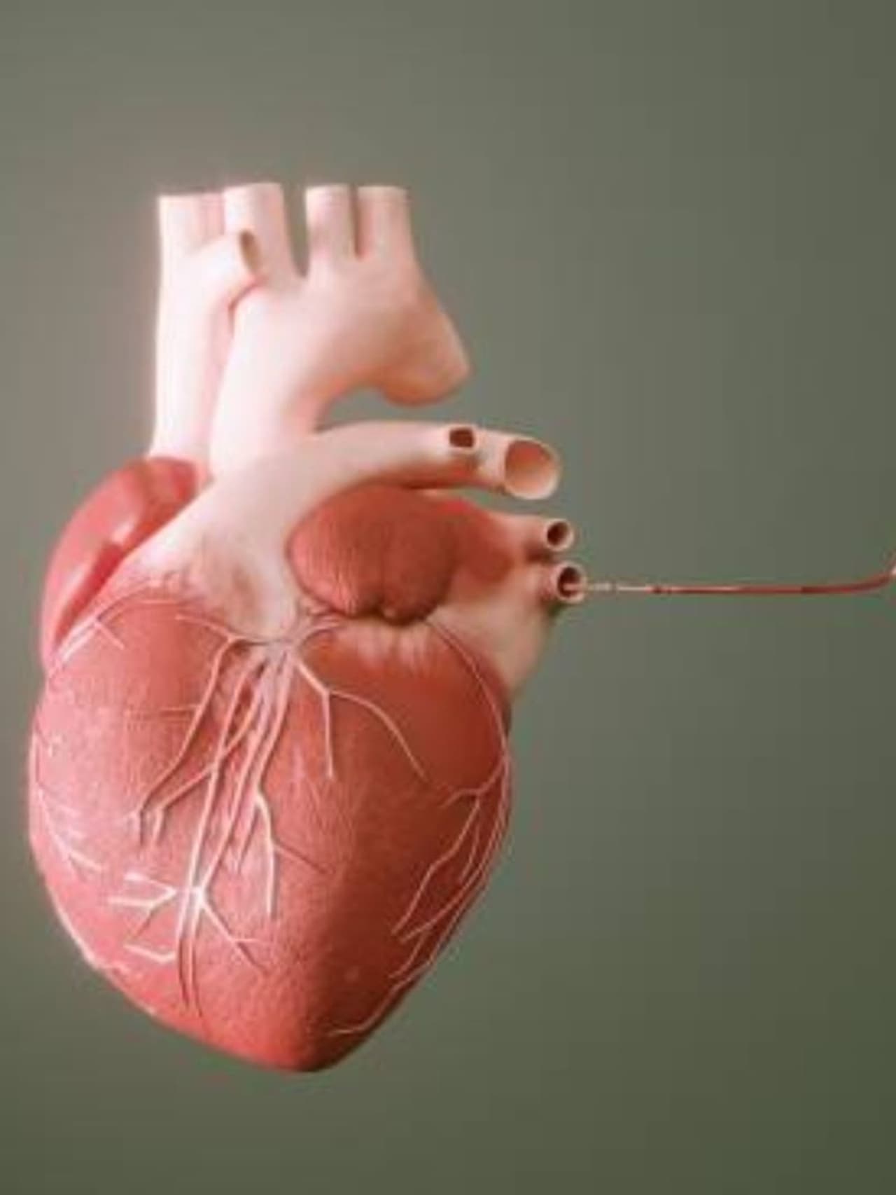 aortic aneurysm అంటే ఇదే.. aortic aneurysm అంటే ఇదే..