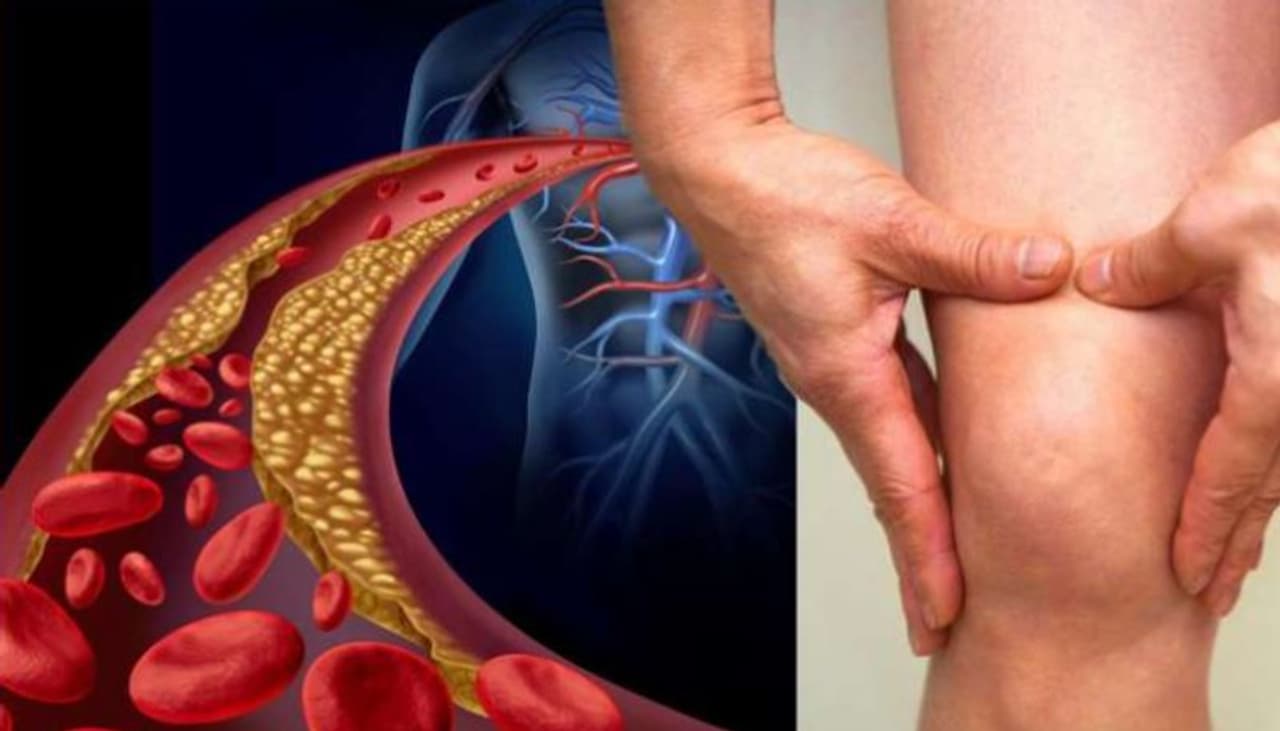 symptoms of cholesterol symptoms of cholesterol