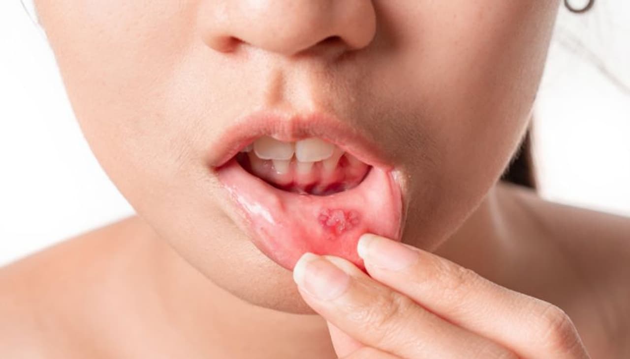 mouth ulcers mouth ulcers