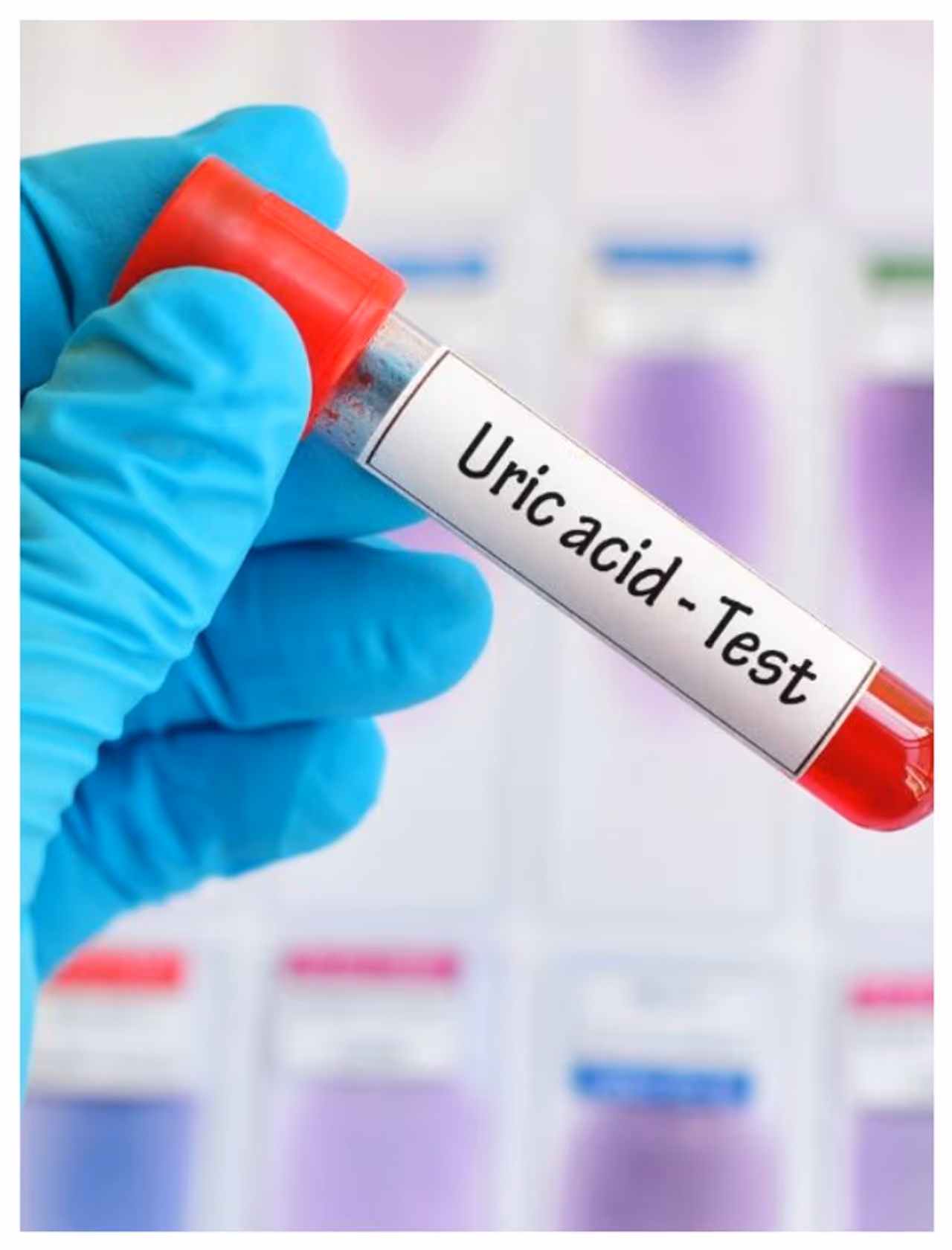 ইউরিক অ্যাসিড বাড়তে দেবেন না! ইউরিক অ্যাসিড বাড়তে দেবেন না!