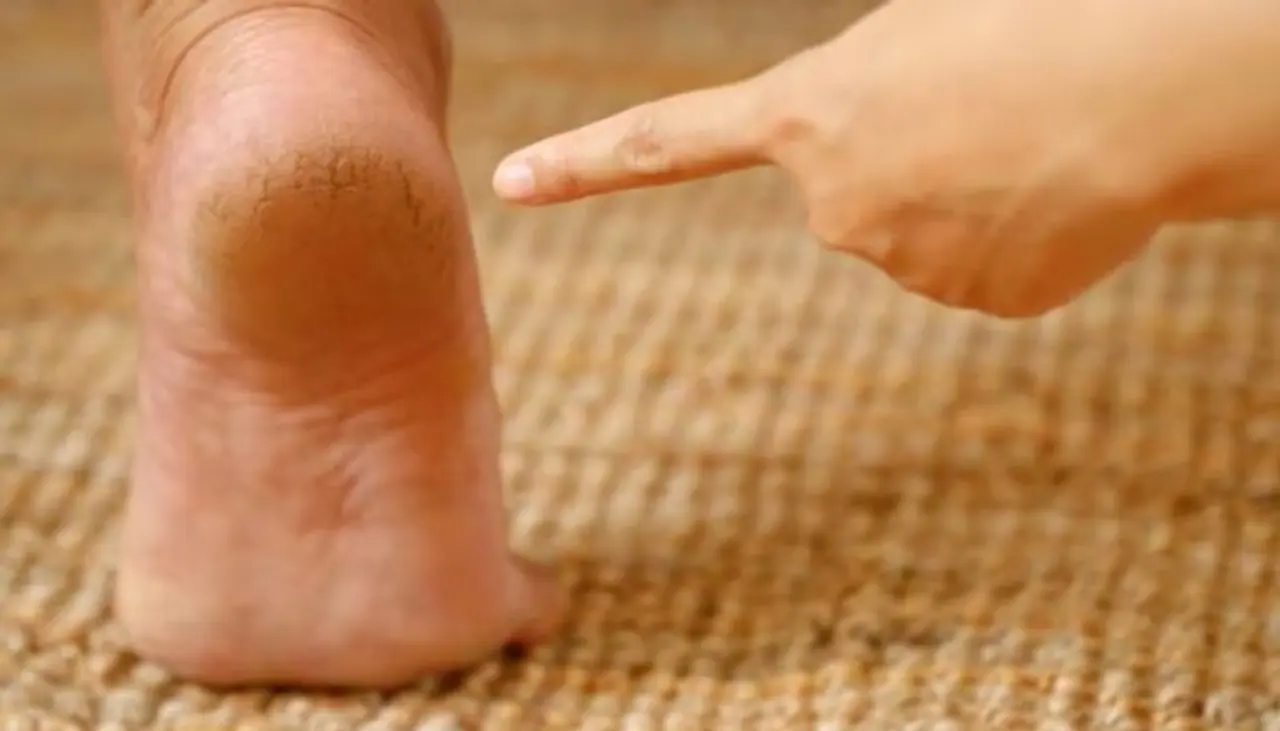 Remedies for Cracked Heels in Winter In Tamil