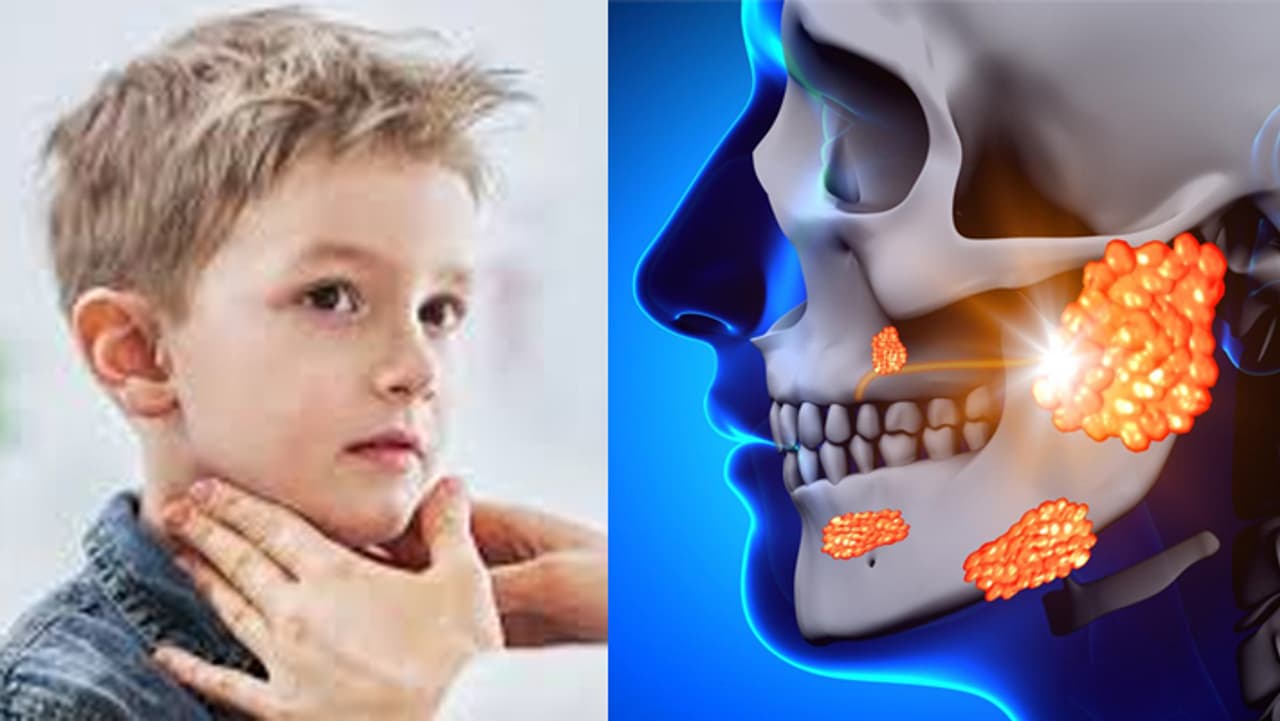 तेजी से बढ़ रहे हैं Mumps के केस तेजी से बढ़ रहे हैं Mumps के केस