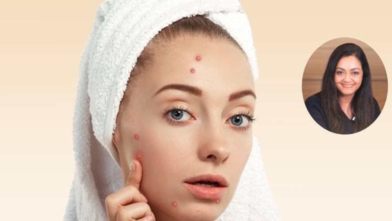 how can get rid of pimples how can get rid of pimples