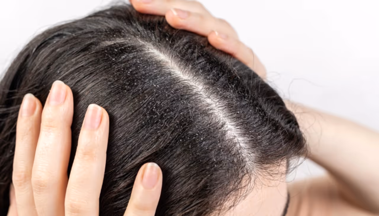 Winter Hair Mask For Dandruff In Tamil Winter Hair Mask For Dandruff In Tamil