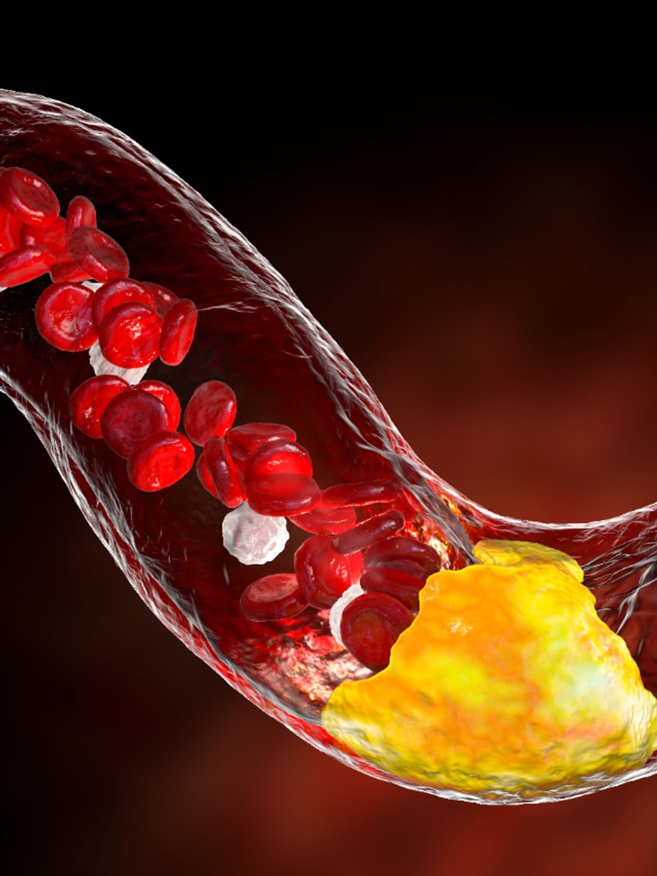 Garlic And Cholesterol Reduction In Tamil