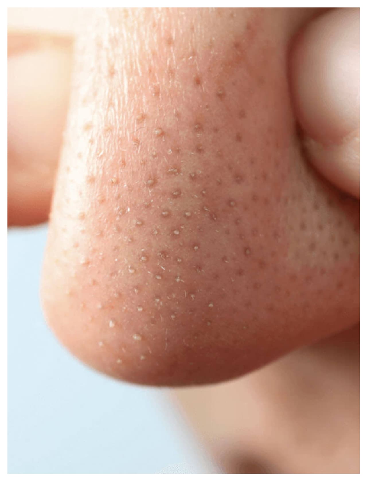 Blackheads