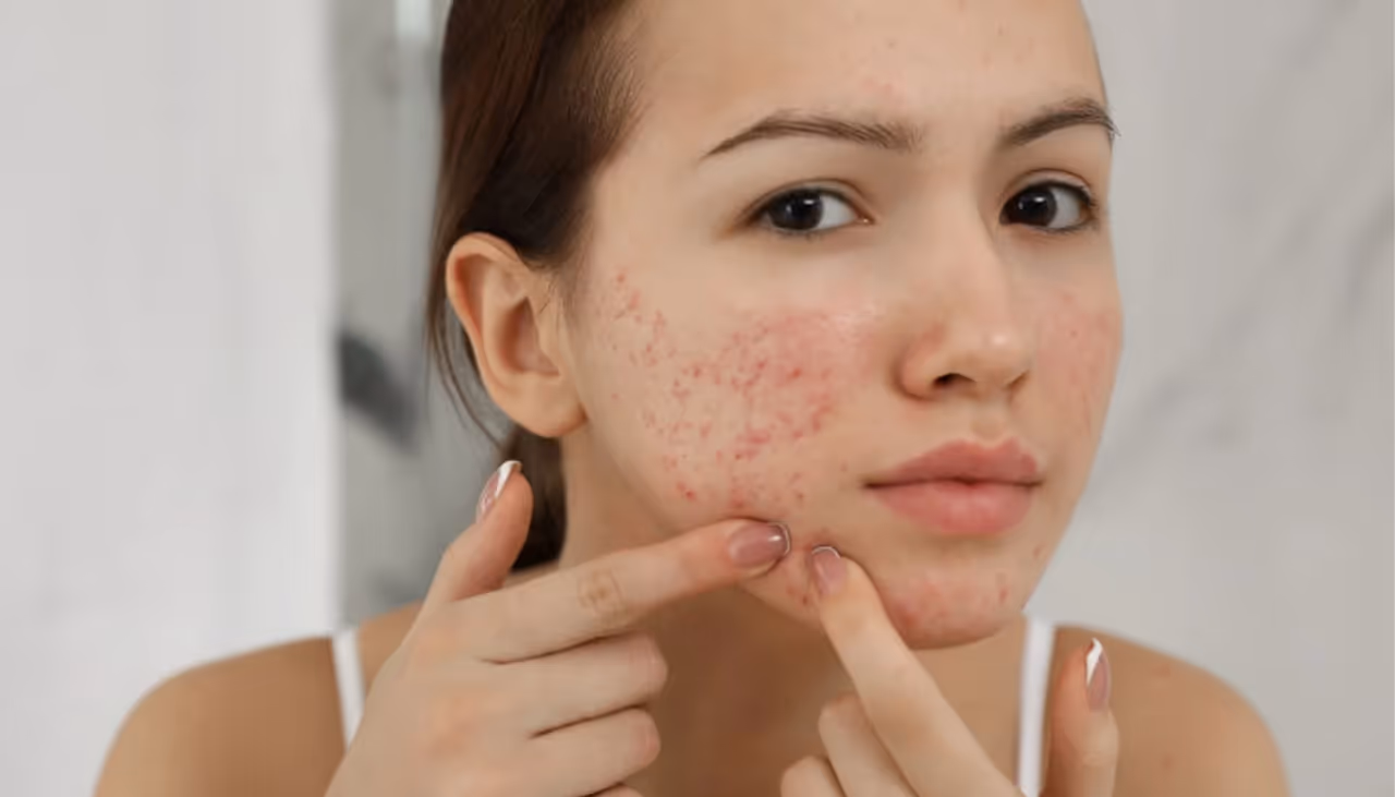 Acne Scars Face Packs