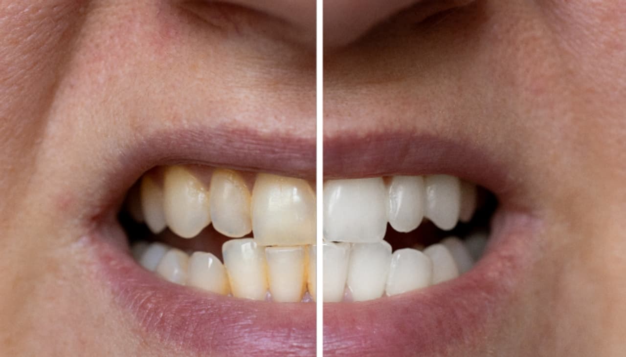 Teeth Stains Removal Tips 