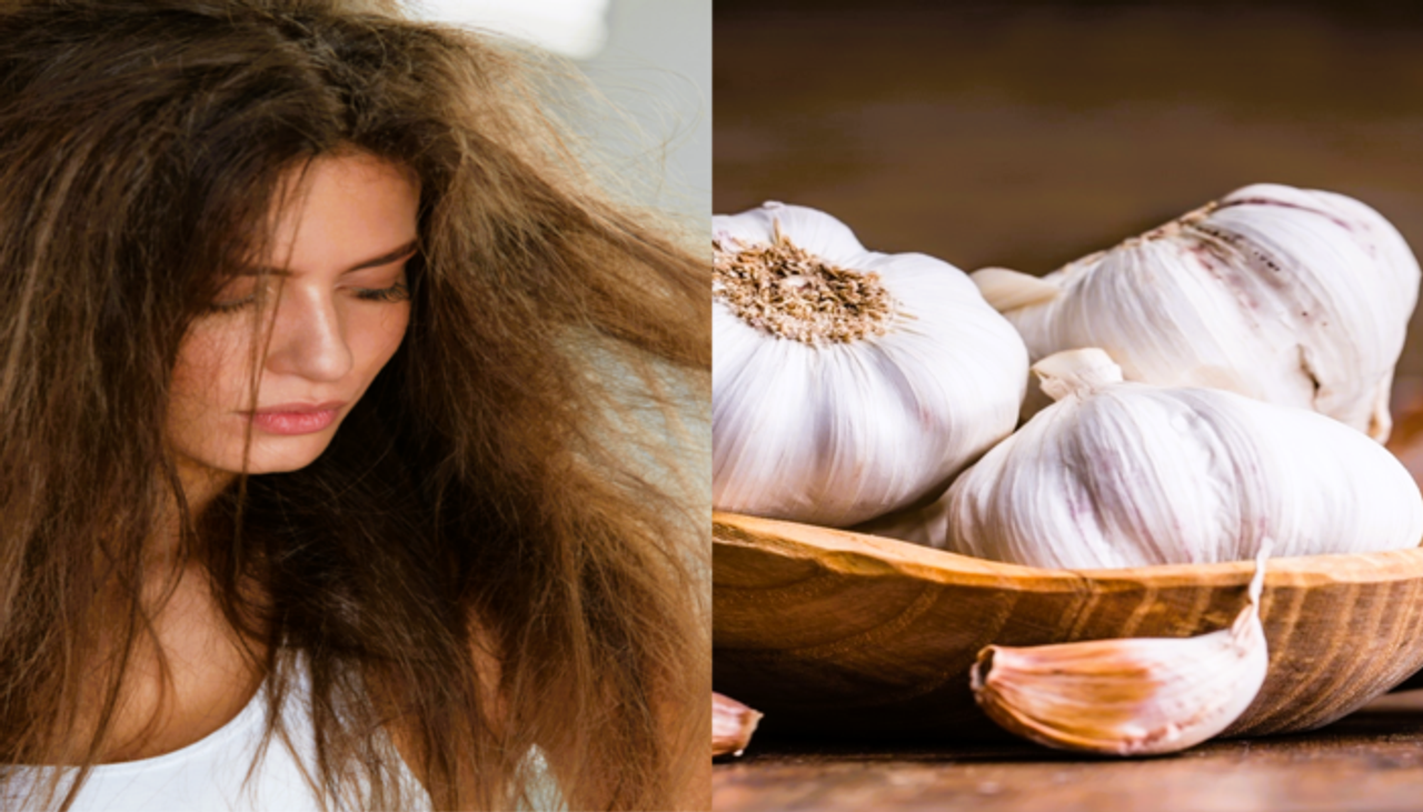 முடி உதிர்தல் முதல் பொடுகு தொல்லை வரை.. ஒரே தீர்வு 'பூண்டு' இப்படி யூஸ் பண்ணுங்க!!