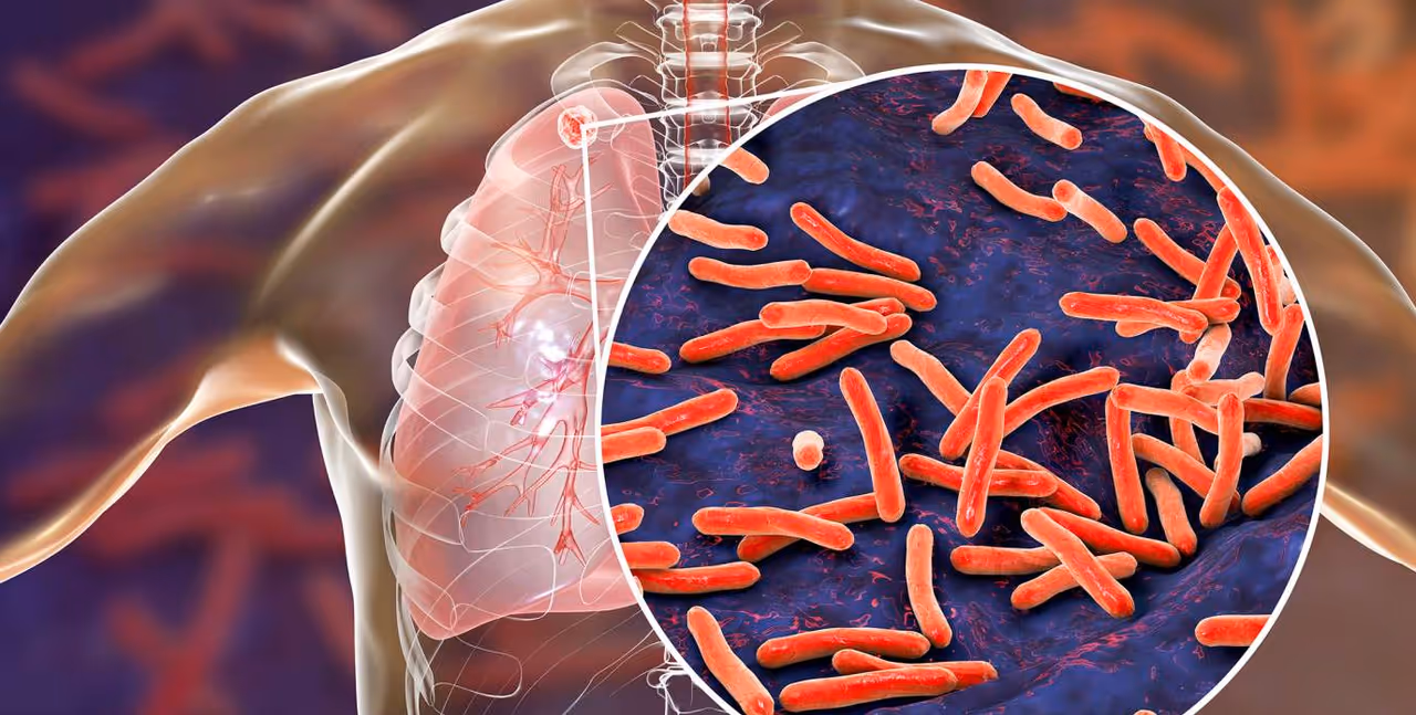 നിങ്ങൾ ഒരിക്കലും അവഗണിക്കാൻ പാടില്ലാത്ത ക്ഷയരോഗത്തിന്റെ ലക്ഷണങ്ങൾ നിങ്ങൾ ഒരിക്കലും അവഗണിക്കാൻ പാടില്ലാത്ത ക്ഷയരോഗത്തിന്റെ ലക്ഷണങ്ങൾ