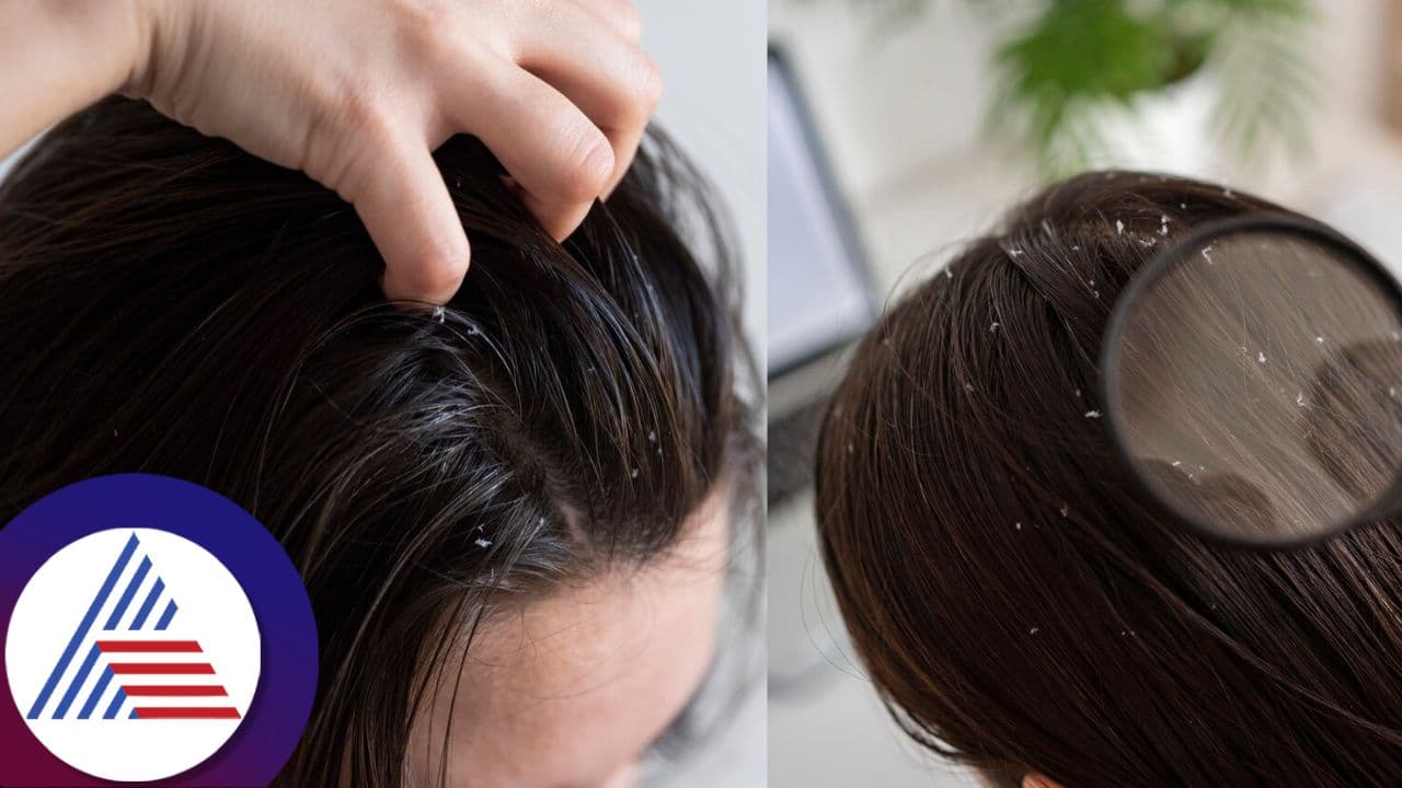 చుండ్రు సమస్యకు చెక్.. చుండ్రు సమస్యకు చెక్..