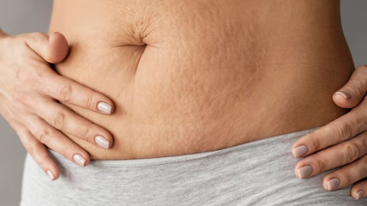 స్ట్రెచ్ మార్క్స్