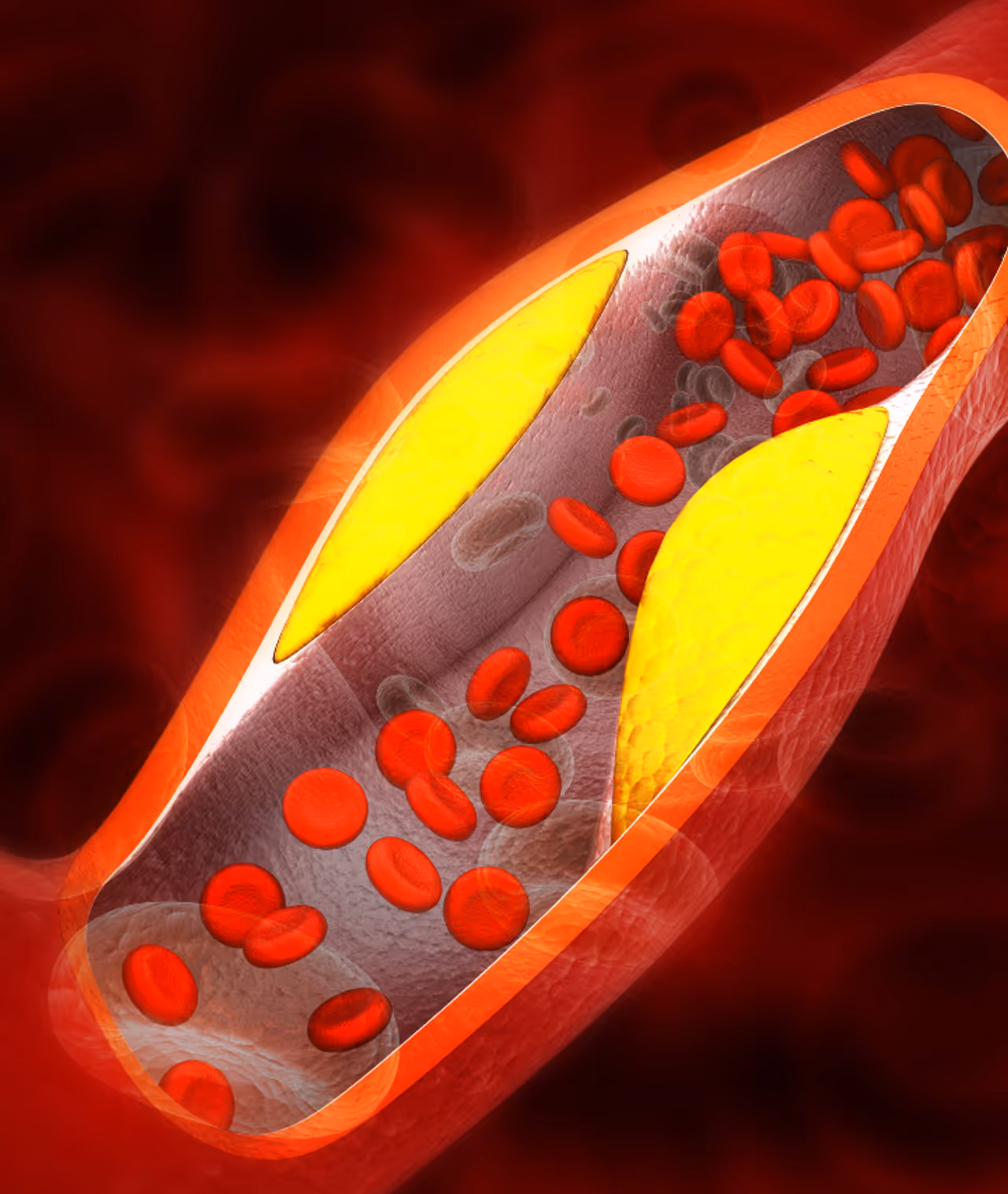 ವರದಿಯಲ್ಲಿತ್ತು ಹೈ ಎಲ್ಡಿಎಲ್ ಕೊಲೆಸ್ಟ್ರಾಲ್ ವರದಿಯಲ್ಲಿತ್ತು ಹೈ ಎಲ್ಡಿಎಲ್ ಕೊಲೆಸ್ಟ್ರಾಲ್