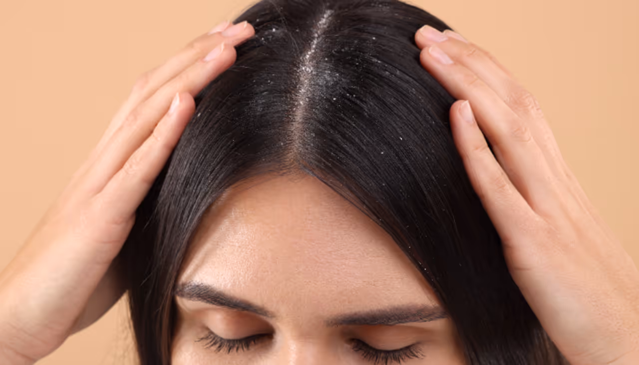 Dandruff Prevention Tips