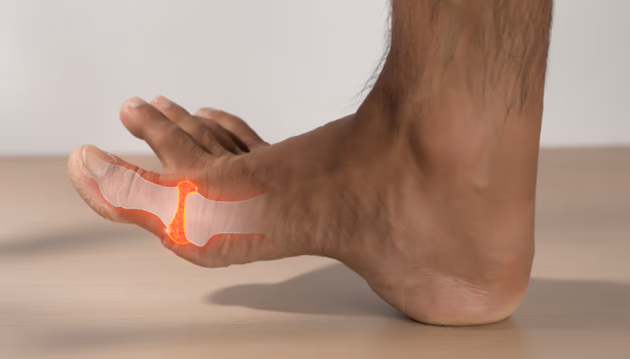 High Uric Acid Symptoms High Uric Acid Symptoms