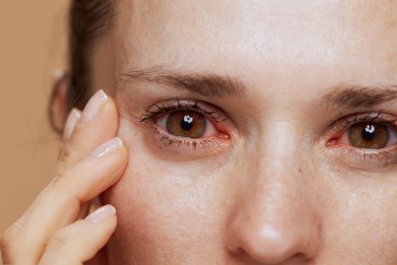 Dry Eyes Remedies at Home Dry Eyes Remedies at Home