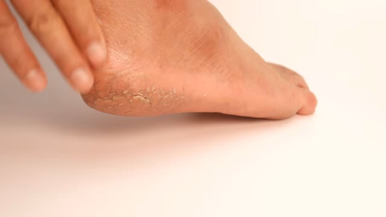 Home Remedies For Cracked Heels In Winter