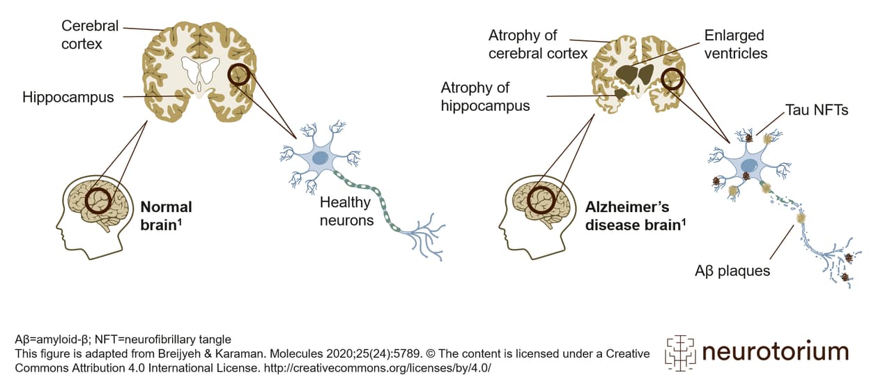 The Alzheimer’s Problem The Alzheimer’s Problem