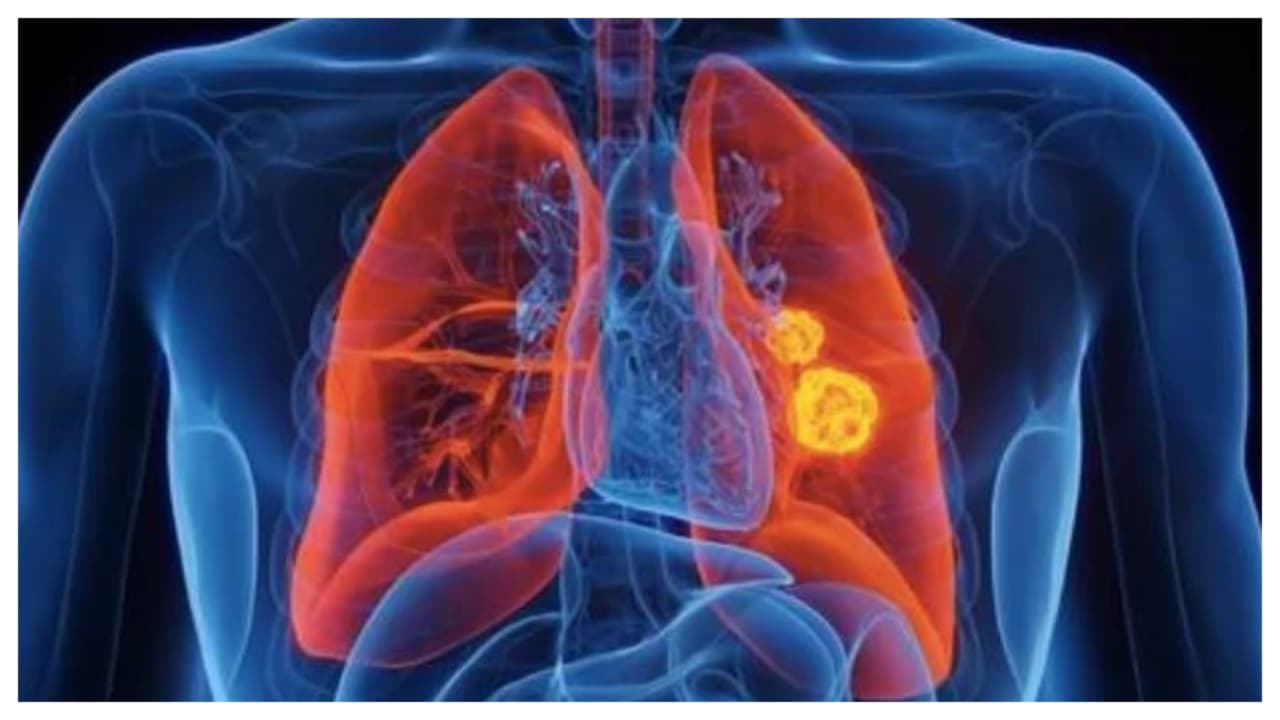 World Lung Cancer Day 2025