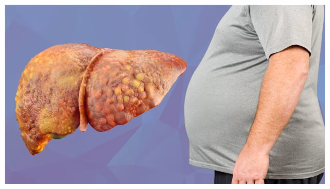 ಫ್ಯಾಟಿ ಲಿವರ್