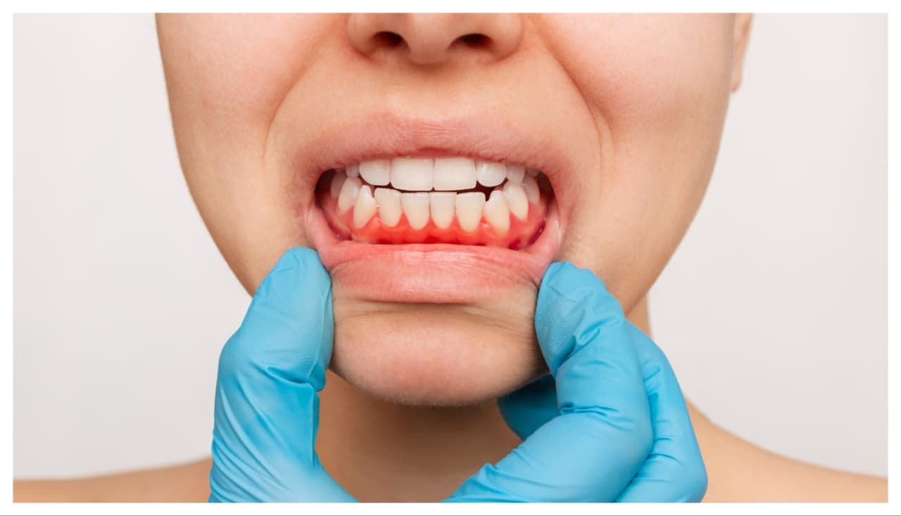 മോണയുടെ ആരോഗ്യം മോണയുടെ ആരോഗ്യം