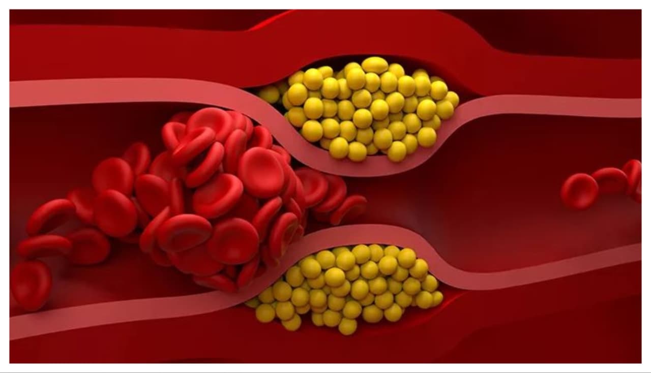 Unhealthy Breakfast for Cholesterol
