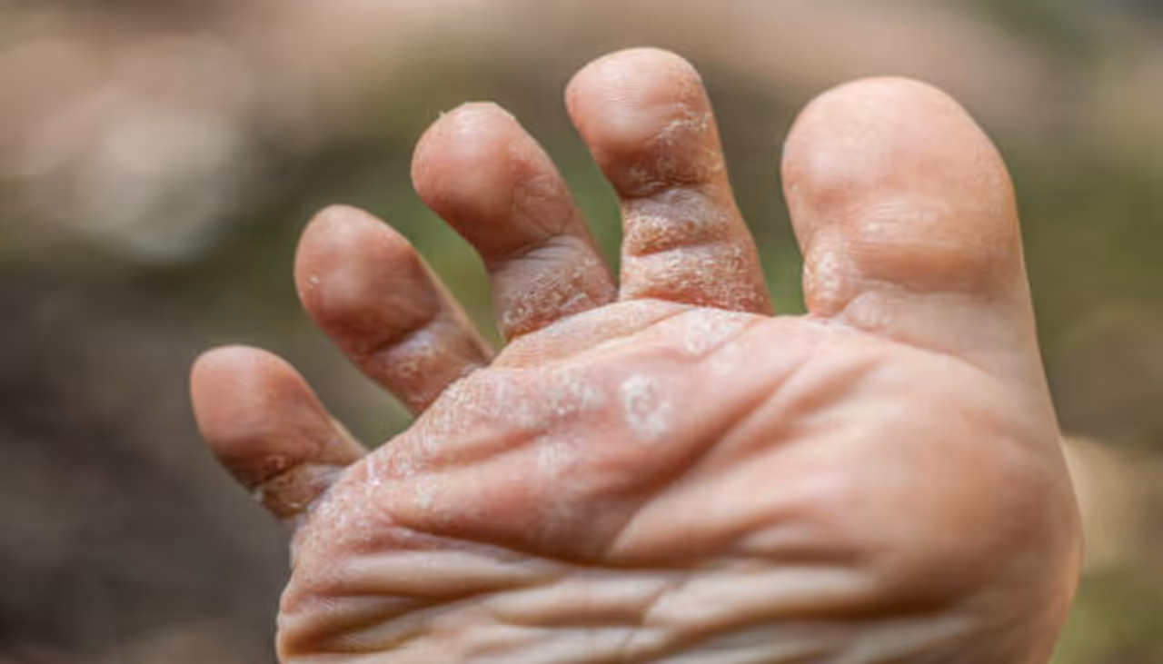 Home Remedies for Foot Fungal Infections