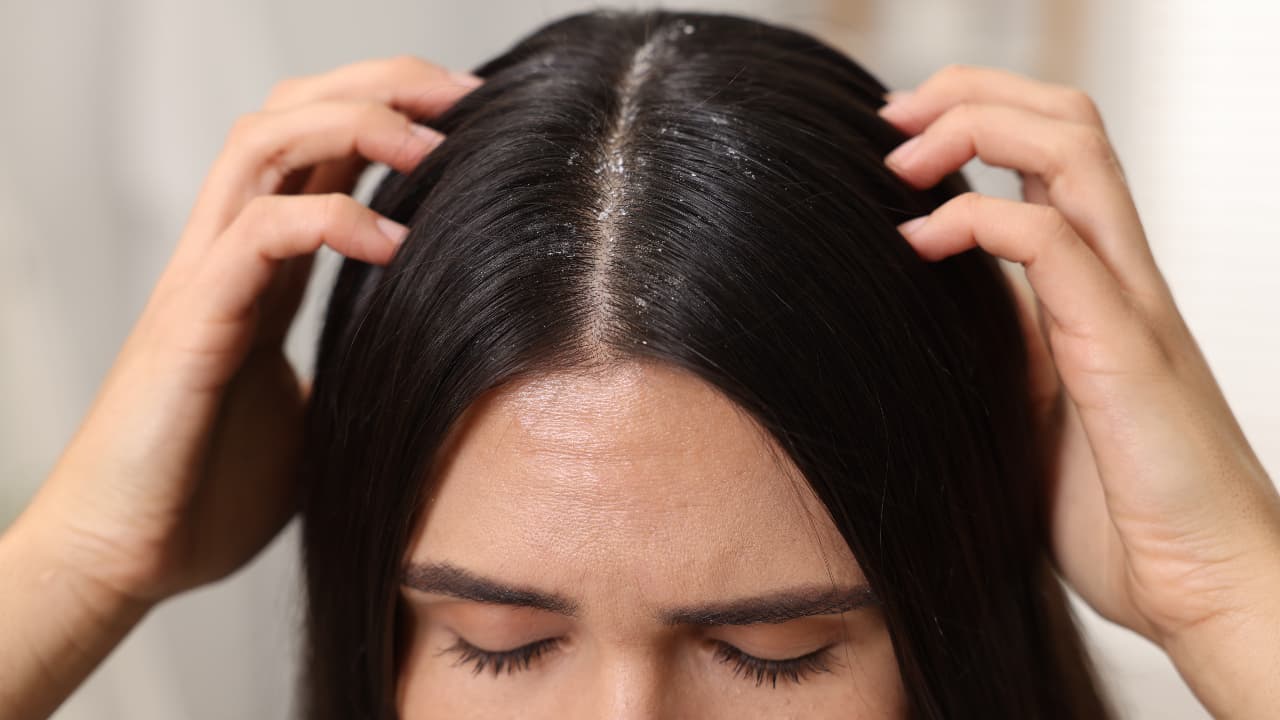 ಕೂದಲು ಉದುರುವಿಕೆಗೆ ಕಾರಣ