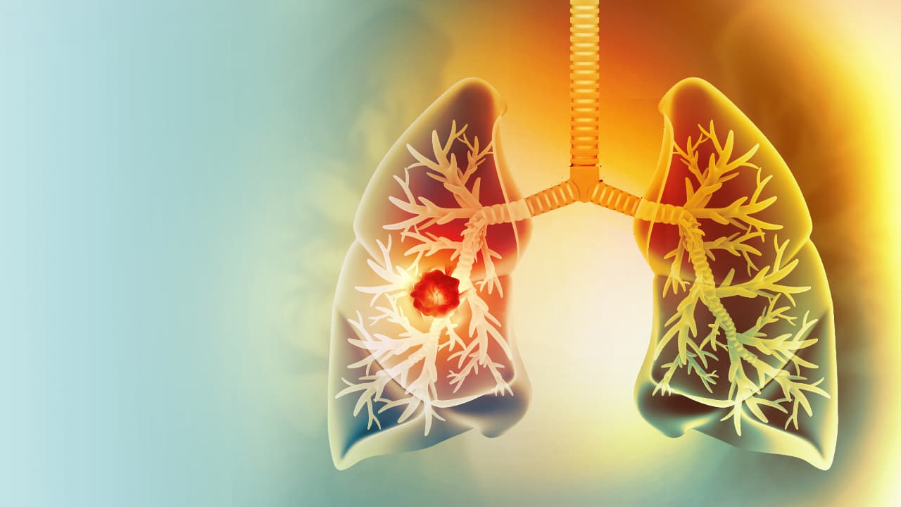 Lung Cancer Symptoms