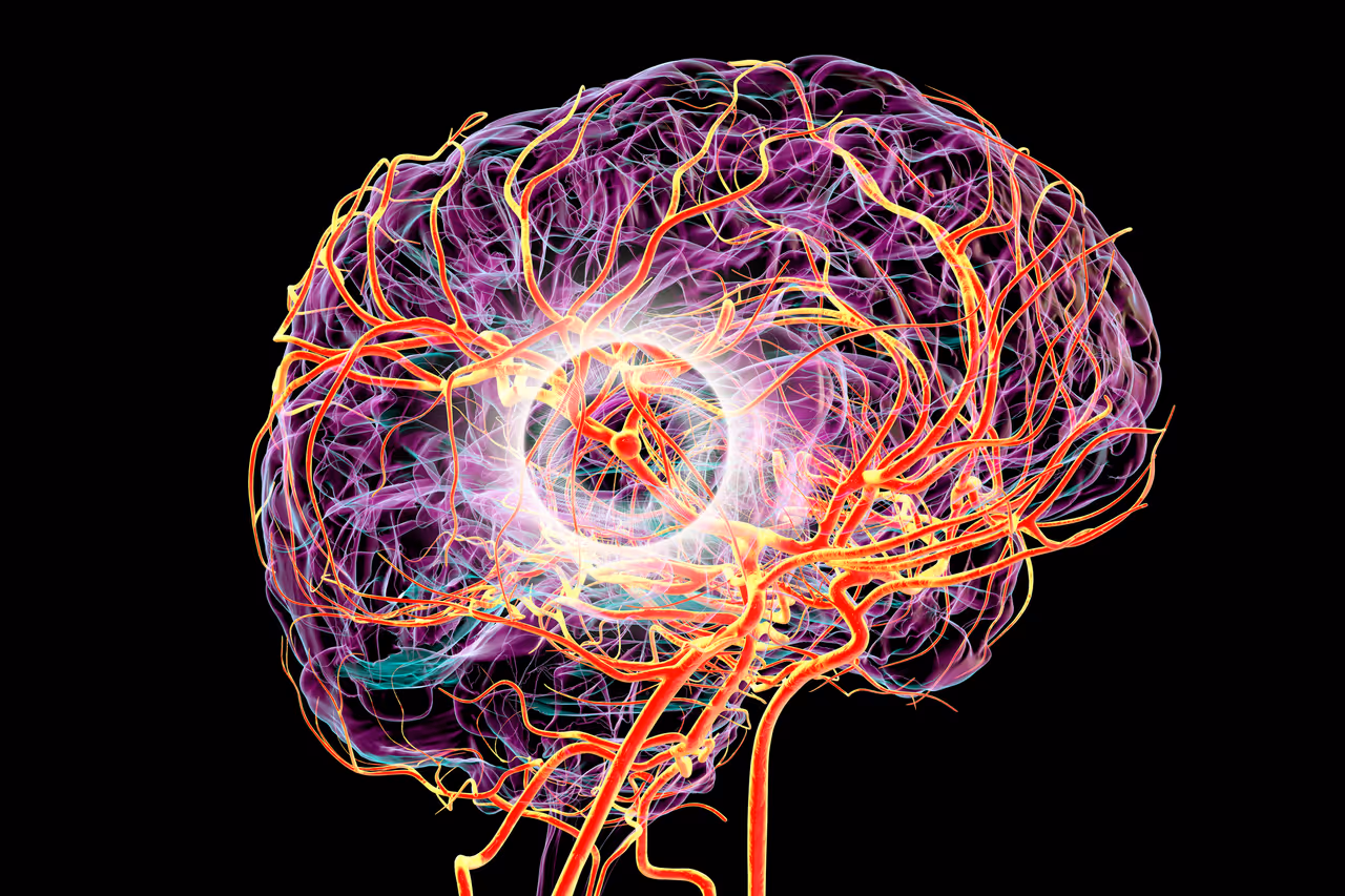 What is Brain Aneurysm? What is Brain Aneurysm?