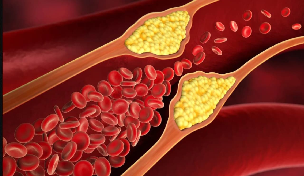 ഉയർന്ന കൊളസ്ട്രോൾ ഇന്ന് മിക്കവരിലും കണ്ട് വരുന്ന പ്രശ്നമാണ്.