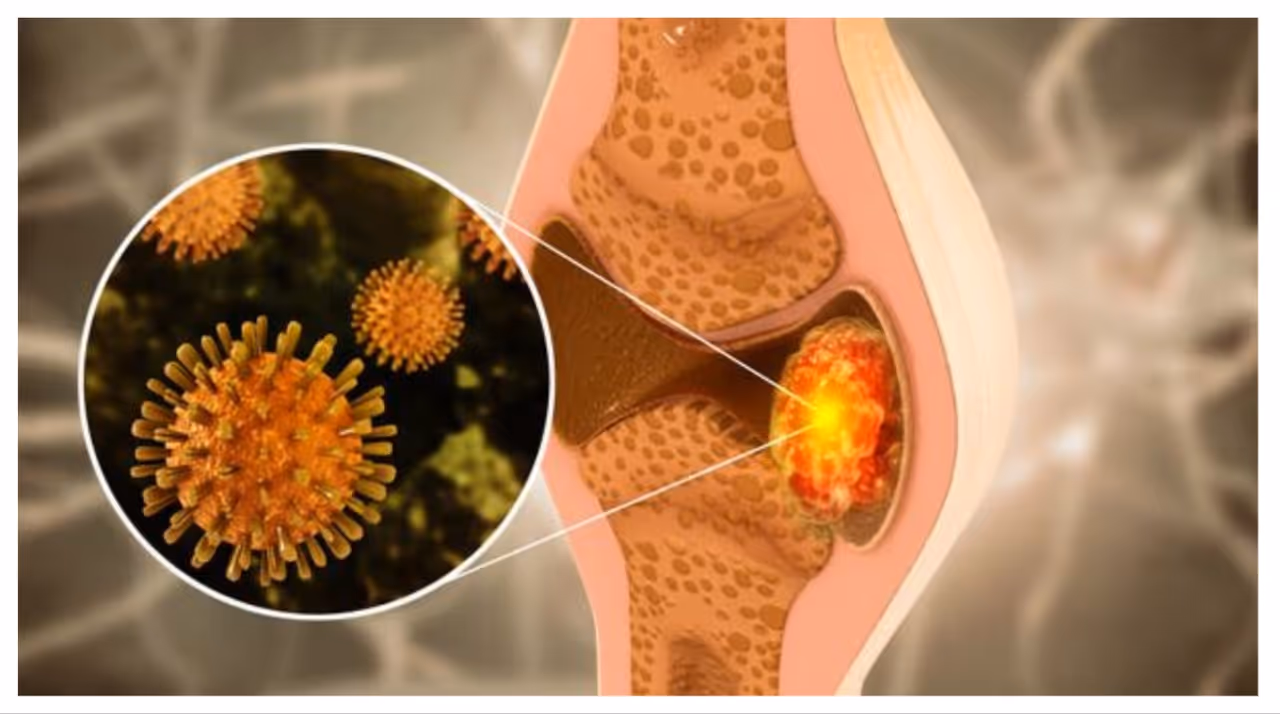 അസ്ഥിയിൽ ആരംഭിക്കുന്ന അർബുദമാണ് അസ്ഥി ക്യാൻസർ.