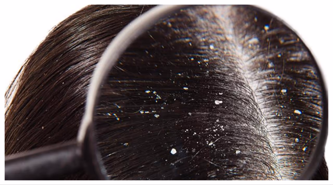 താരനാണോ പ്രശ്നം? പരീക്ഷിക്കാം ഈ നാല് പൊടിക്കെെകൾ താരനാണോ പ്രശ്നം? പരീക്ഷിക്കാം ഈ നാല് പൊടിക്കെെകൾ