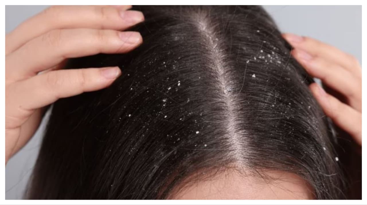 Coffee for Dandruff Control Coffee for Dandruff Control