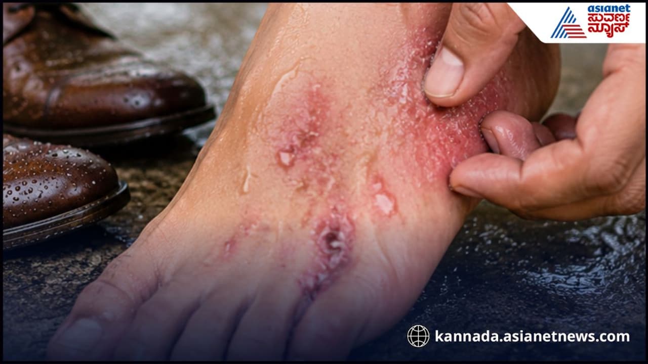ಸೋಂಕು ಸೋಂಕು