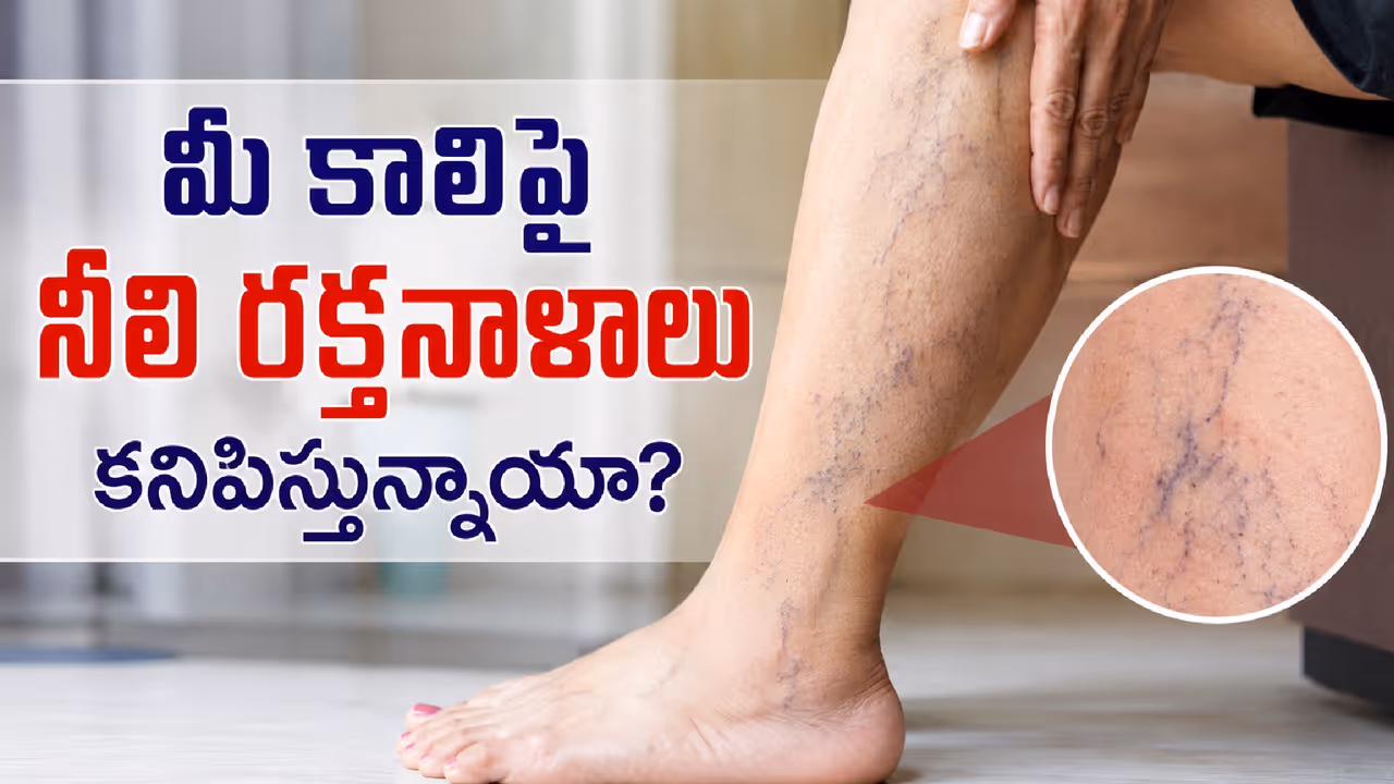 కాళ్లపై కనిపించే రక్తనాళాలు కాళ్లపై కనిపించే రక్తనాళాలు