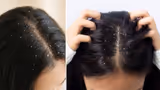 Dandruff: కొబ్బరి నూనెలో ఇదొక్కటి కలిపి రాస్తే చుండ్రు మళ్లీ రాదు
